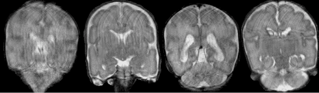 Figure 1 for Generative adversarial network for segmentation of motion affected neonatal brain MRI