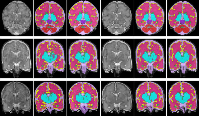 Figure 4 for Generative adversarial network for segmentation of motion affected neonatal brain MRI