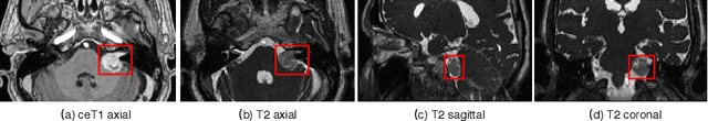 Figure 1 for Automatic Segmentation of Vestibular Schwannoma from T2-Weighted MRI by Deep Spatial Attention with Hardness-Weighted Loss