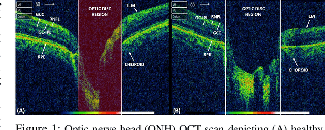 Figure 1 for Clinically Verified Hybrid Deep Learning System for Retinal Ganglion Cells Aware Grading of Glaucomatous Progression