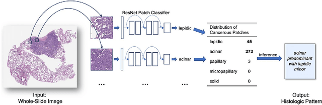 Figure 1 for Pathologist-level classification of histologic patterns on resected lung adenocarcinoma slides with deep neural networks