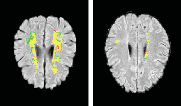 Figure 1 for Soft labeling by Distilling Anatomical knowledge for Improved MS Lesion Segmentation