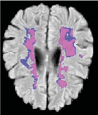 Figure 3 for Soft labeling by Distilling Anatomical knowledge for Improved MS Lesion Segmentation