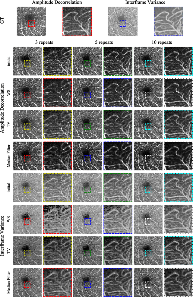 Figure 4 for Maximum a posteriori signal recovery for optical coherence tomography angiography image generation and denoising