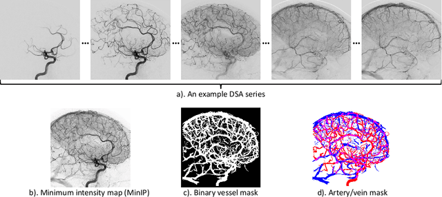 Figure 1 for Spatio-Temporal U-Net for Cerebral Artery and Vein Segmentation in Digital Subtraction Angiography