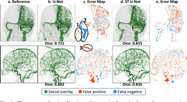 Figure 4 for Spatio-Temporal U-Net for Cerebral Artery and Vein Segmentation in Digital Subtraction Angiography