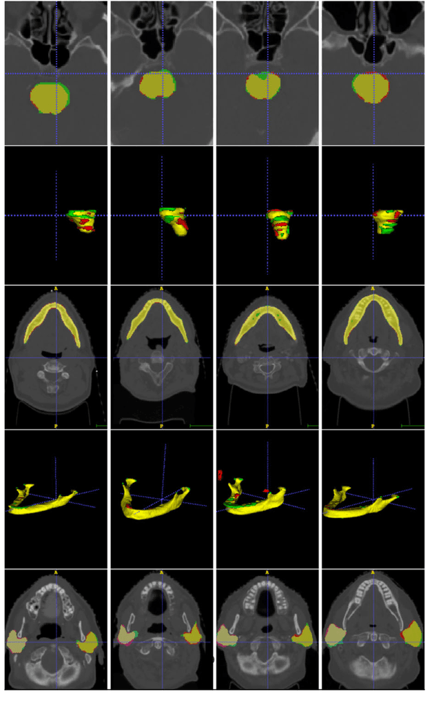 Figure 3 for AnatomyNet: Deep 3D Squeeze-and-excitation U-Nets for fast and fully automated whole-volume anatomical segmentation