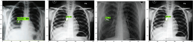 Figure 4 for Interpretation of Chest x-rays affected by bullets using deep transfer learning