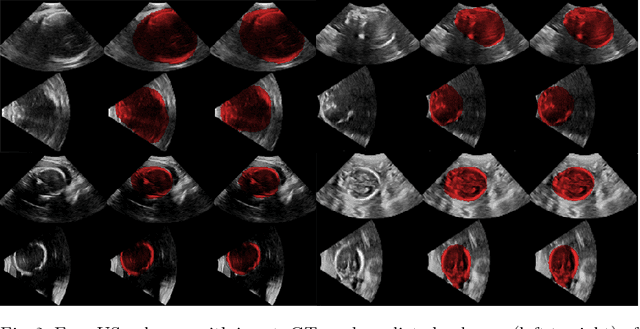 Figure 3 for EchoFusion: Tracking and Reconstruction of Objects in 4D Freehand Ultrasound Imaging without External Trackers