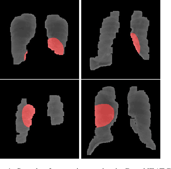 Figure 1 for Genetic Deep Learning for Lung Cancer Screening