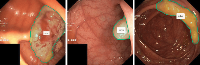 Figure 1 for Kvasir-SEG: A Segmented Polyp Dataset