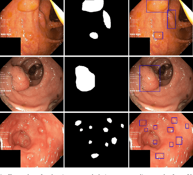 Figure 3 for Kvasir-SEG: A Segmented Polyp Dataset