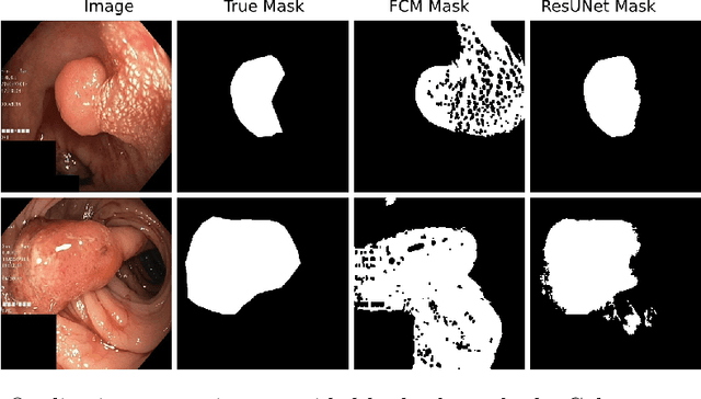 Figure 4 for Kvasir-SEG: A Segmented Polyp Dataset