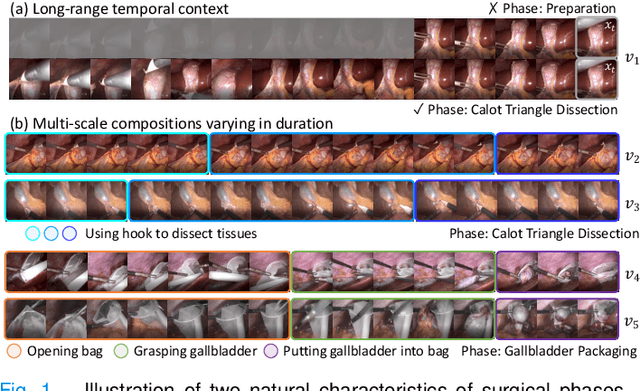 Figure 1 for Temporal Memory Relation Network for Workflow Recognition from Surgical Video