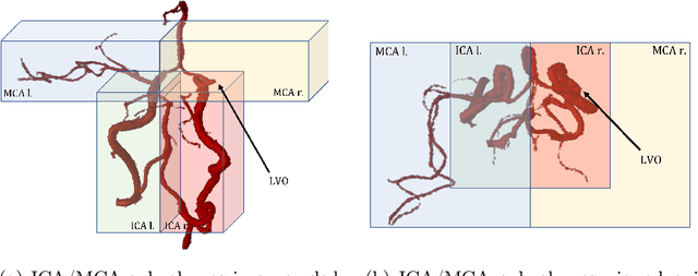 Figure 3 for Building Brains: Subvolume Recombination for Data Augmentation in Large Vessel Occlusion Detection