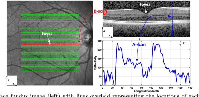 Figure 1 for Automated Segmentation of Retinal Layers from Optical Coherent Tomography Images Using Geodesic Distance
