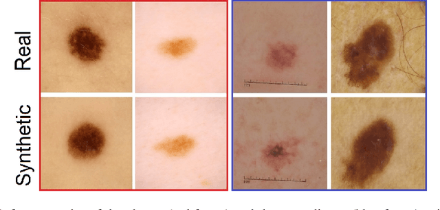 Figure 4 for GAN-based generative modelling for dermatological applications -- comparative study