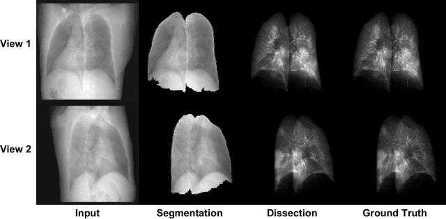 Figure 4 for X-ray Dissectography Enables Stereotography to Improve Diagnostic Performance