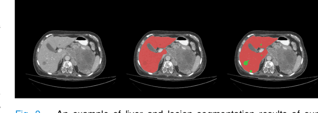 Figure 3 for Context-aware PolyUNet for Liver and Lesion Segmentation from Abdominal CT Images