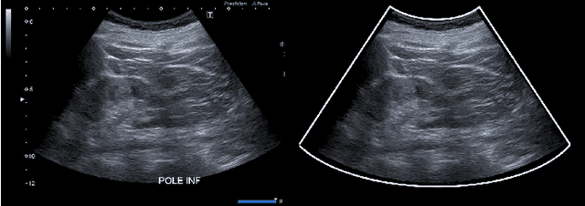 Figure 1 for Combining Bayesian and Deep Learning Methods for the Delineation of the Fan in Ultrasound Images