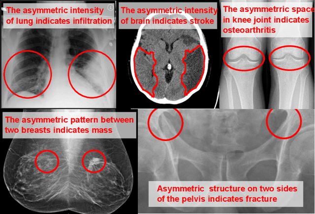 Figure 1 for Anatomy-Aware Siamese Network: Exploiting Semantic Asymmetry for Accurate Pelvic Fracture Detection in X-ray Images