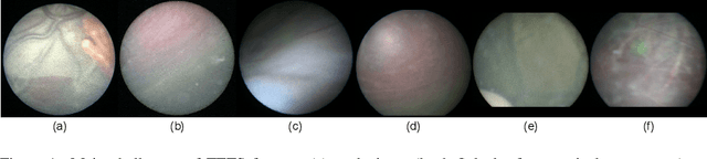 Figure 1 for Learning-Based Keypoint Registration for Fetoscopic Mosaicking