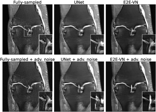 Figure 2 for Adversarial Robustness of MR Image Reconstruction under Realistic Perturbations