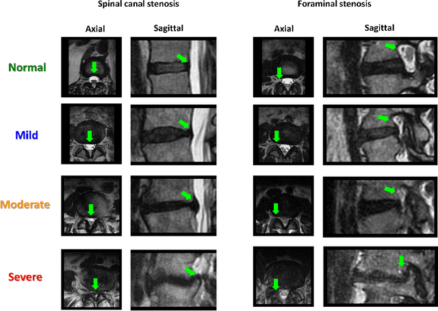 Figure 1 for DeepSPINE: Automated Lumbar Vertebral Segmentation, Disc-level Designation, and Spinal Stenosis Grading Using Deep Learning