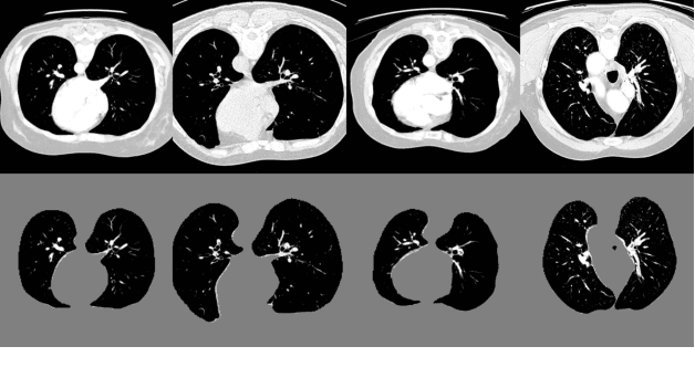 Figure 1 for Label-Free Segmentation of COVID-19 Lesions in Lung CT