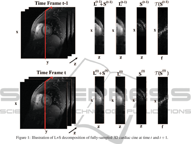Figure 1 for Low-Rank and Sparse Matrix Decomposition with a-priori knowledge for Dynamic 3D MRI reconstruction