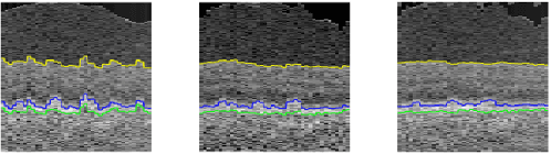 Figure 3 for Simultaneous Alignment and Surface Regression Using Hybrid 2D-3D Networks for 3D Coherent Layer Segmentation of Retina OCT Images