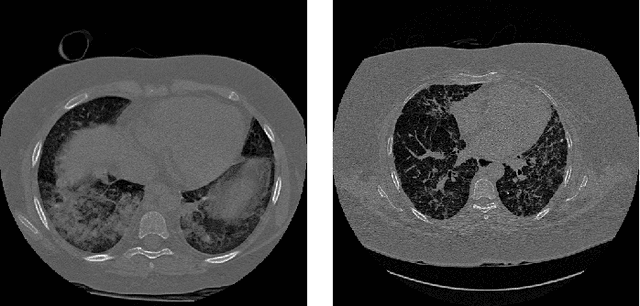 Figure 1 for Extracting Lungs from CT Images using Fully Convolutional Networks