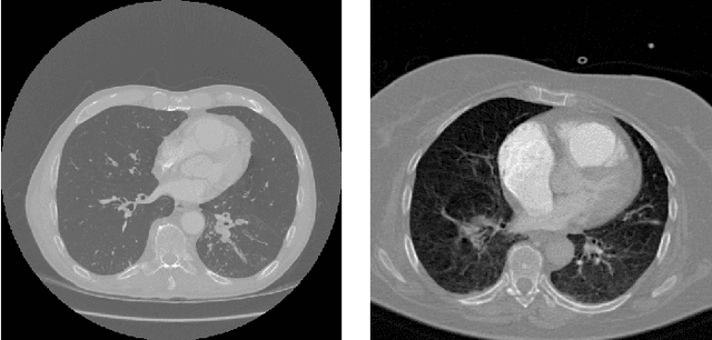 Figure 2 for Extracting Lungs from CT Images using Fully Convolutional Networks