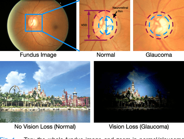 Figure 1 for Disc-aware Ensemble Network for Glaucoma Screening from Fundus Image