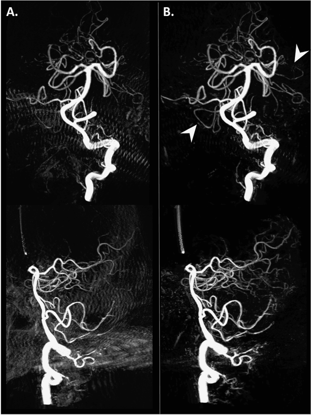 Figure 4 for Deep Learning Angiography (DLA): Three-dimensional C-arm Cone Beam CT Angiography Using Deep Learning