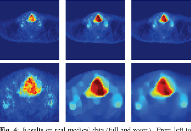 Figure 4 for Post-Reconstruction Deconvolution of PET Images by Total Generalized Variation Regularization