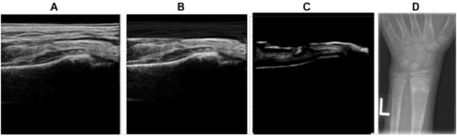 Figure 2 for Domain Specific Transporter Framework to Detect Fractures in Ultrasound