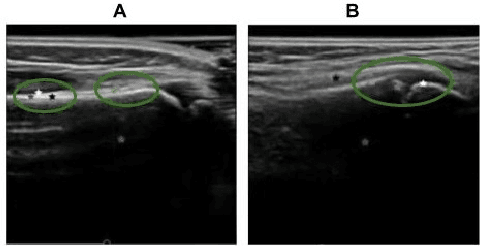 Figure 3 for Domain Specific Transporter Framework to Detect Fractures in Ultrasound
