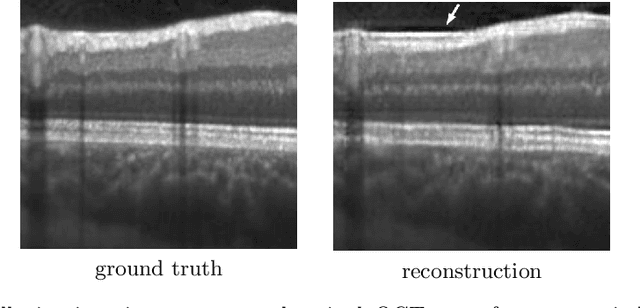 Figure 1 for Uncertainty Estimation in Medical Image Denoising with Bayesian Deep Image Prior