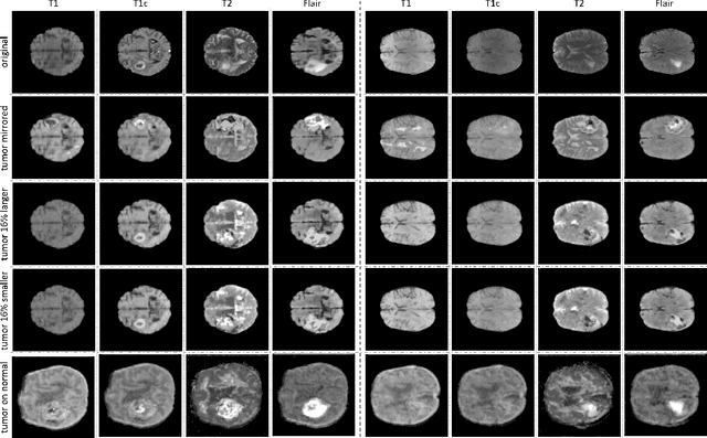 Figure 4 for Medical Image Synthesis for Data Augmentation and Anonymization using Generative Adversarial Networks
