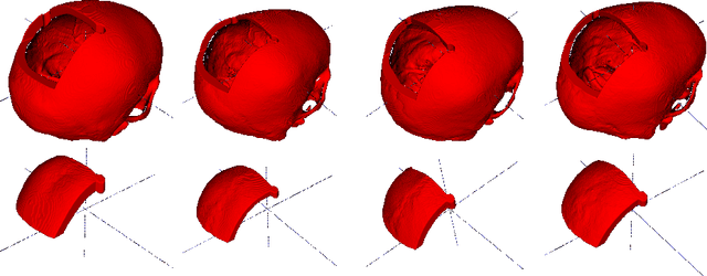 Figure 1 for Cranial Implant Prediction using Low-Resolution 3D Shape Completion and High-Resolution 2D Refinement