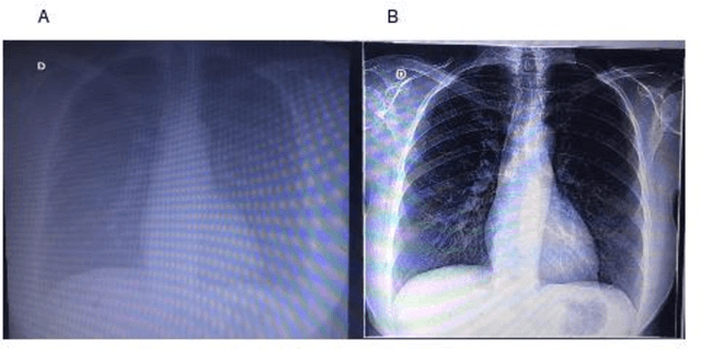 Figure 4 for Intelligent computational model for the classification of Covid-19 with chest radiography compared to other respiratory diseases