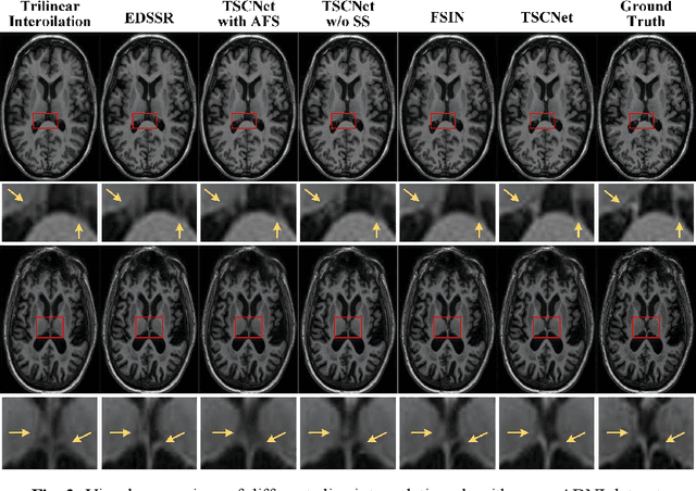 Figure 4 for Two-Stage Self-Supervised Cycle-Consistency Network for Reconstruction of Thin-Slice MR Images