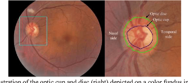 Figure 1 for Performance assessment of the deep learning technologies in grading glaucoma severity