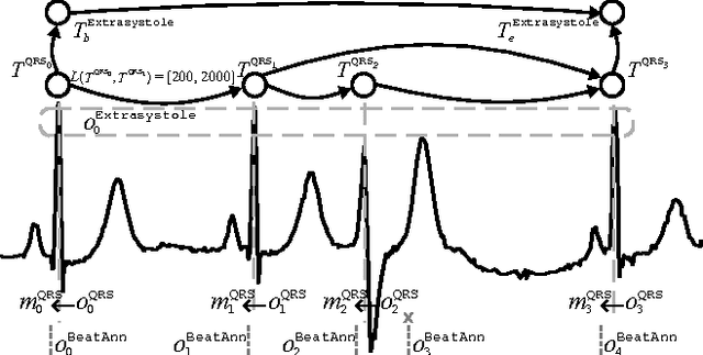 Figure 1 for Using temporal abduction for biosignal interpretation: A case study on QRS detection