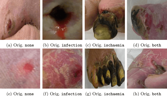 Figure 1 for Boosting EfficientNets Ensemble Performance via Pseudo-Labels and Synthetic Images by pix2pixHD for Infection and Ischaemia Classification in Diabetic Foot Ulcers