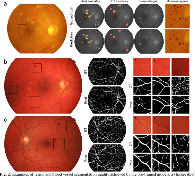 Figure 3 for Self-Supervised Learning from Unlabeled Fundus Photographs Improves Segmentation of the Retina