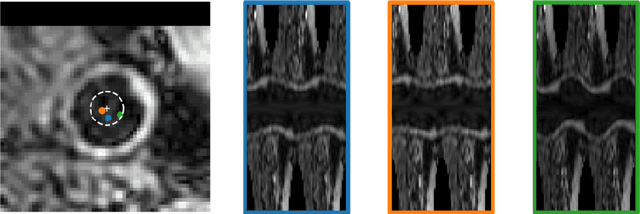 Figure 2 for Deep Learning-Based Carotid Artery Vessel Wall Segmentation in Black-Blood MRI Using Anatomical Priors