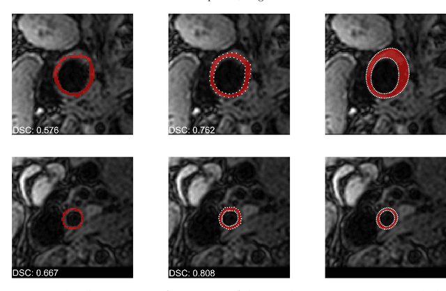 Figure 4 for Deep Learning-Based Carotid Artery Vessel Wall Segmentation in Black-Blood MRI Using Anatomical Priors