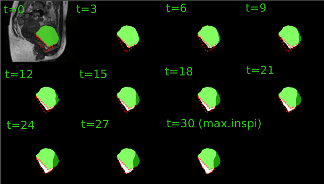 Figure 4 for Characterization of surface motion patterns in highly deformable soft tissue organs from dynamic Magnetic Resonance Imaging